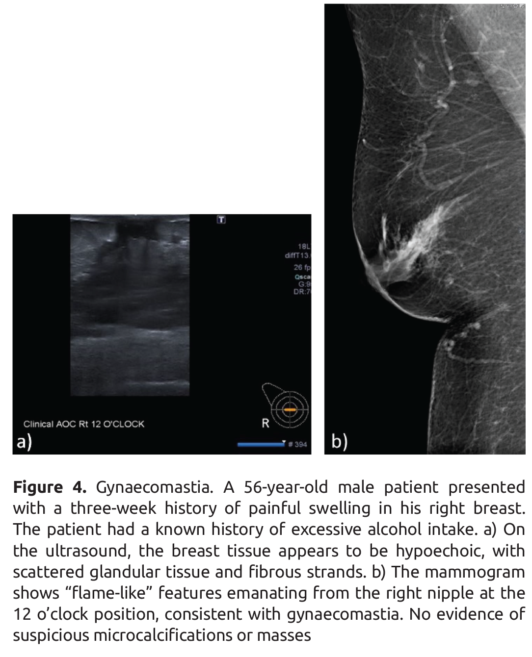Is Breast Imaging in Male Patients With Benign Lumps Necessary? A
