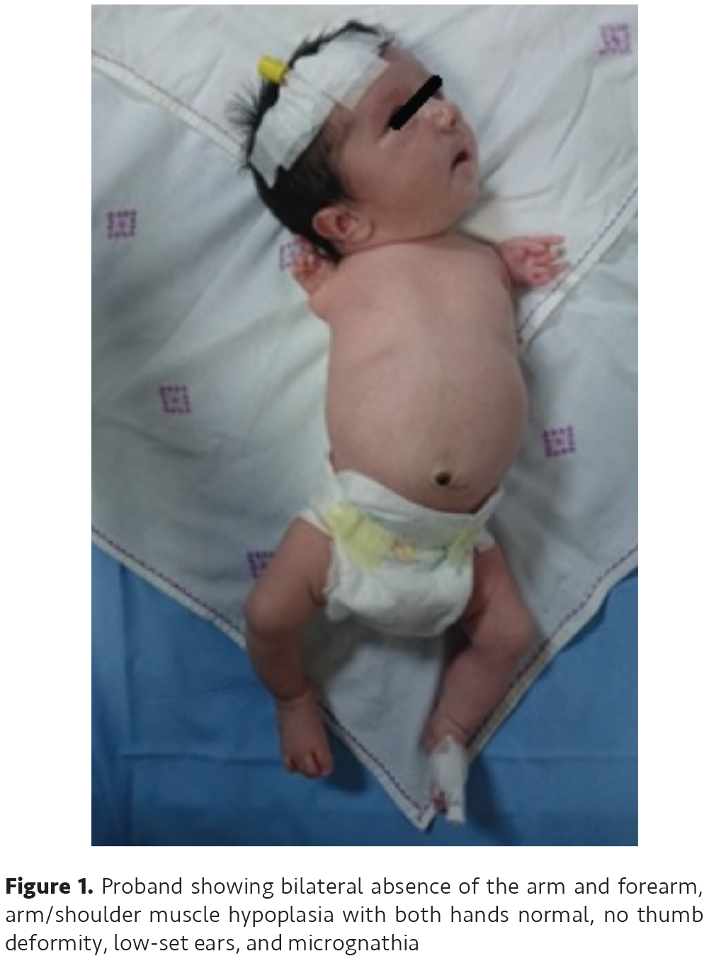 Severe Extremity Anomaly and Neurodevelopmental Retardation in an