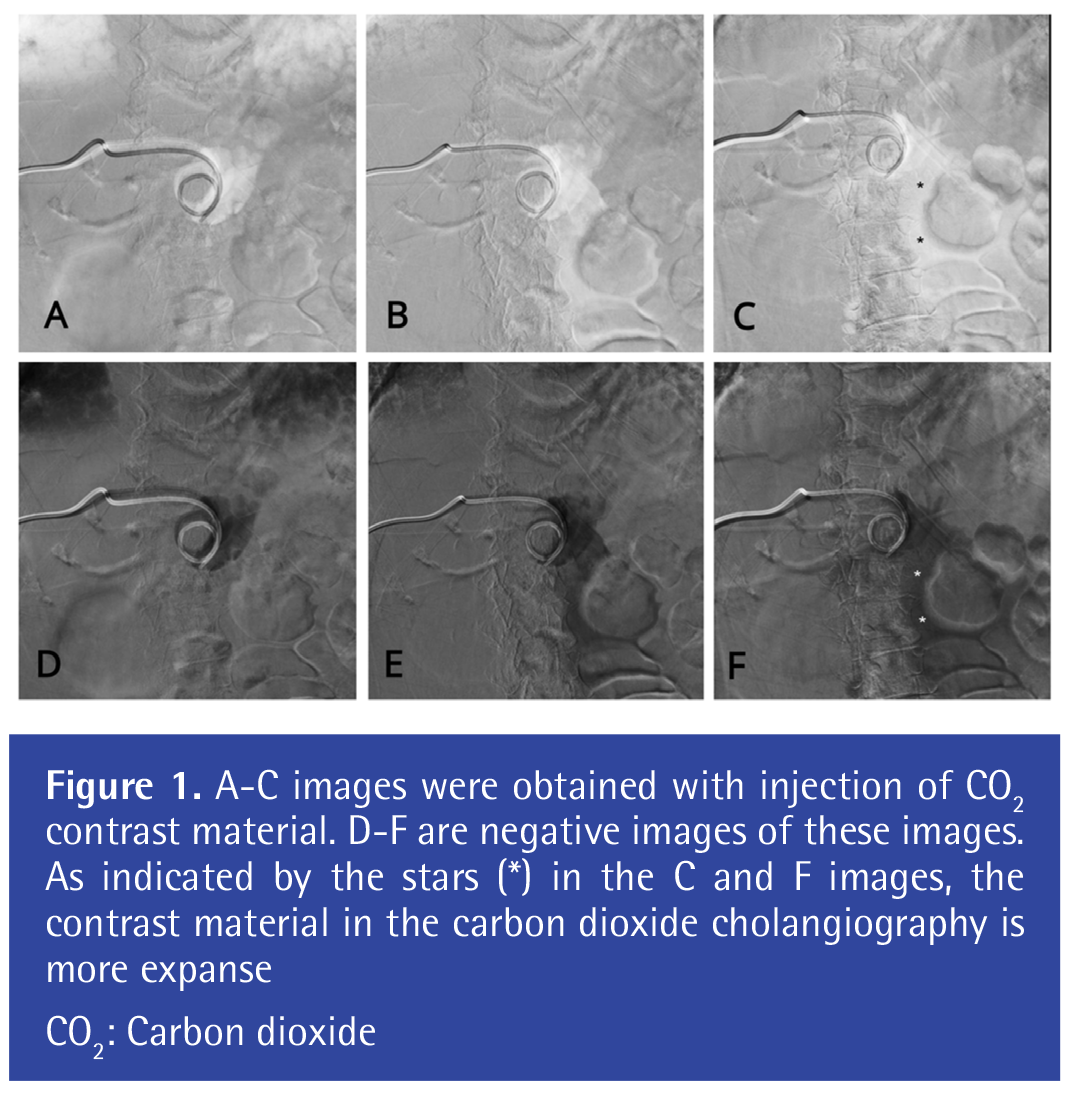 Carbon Dioxide Cholangiography in Diagnosis of Gallbladder Perforation ...