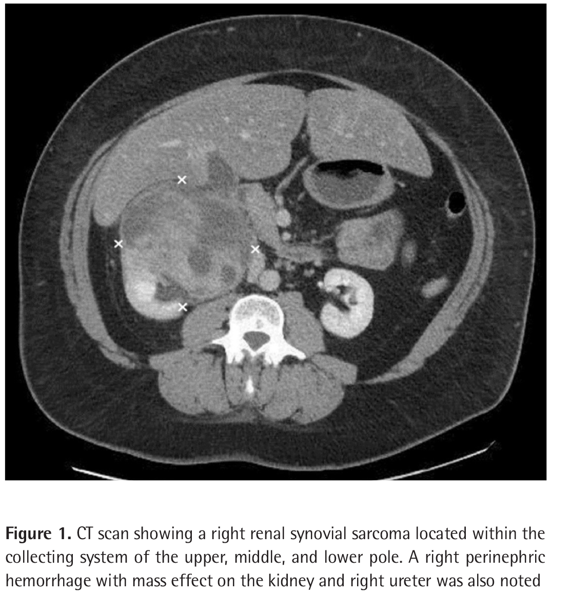 Primary Renal Synovial Journal of Urological Surgery