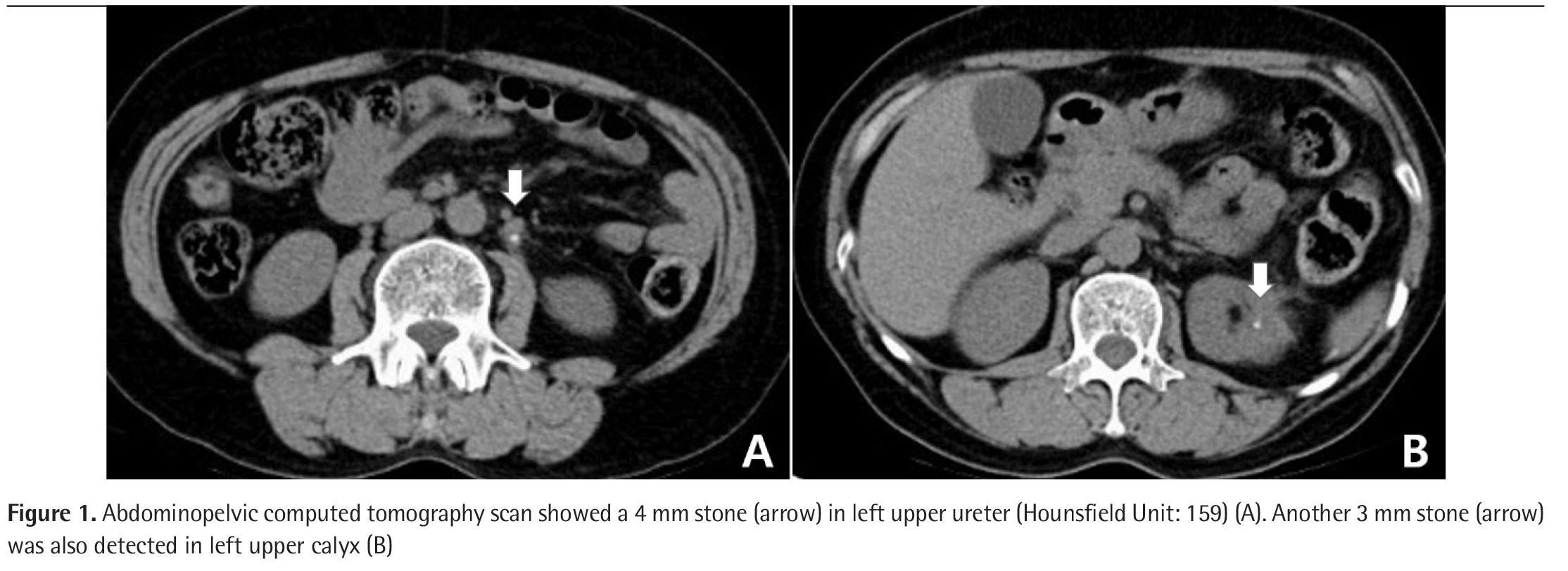 Migration of LAPRATY Clips in Ureter and Collecting System Mimicking