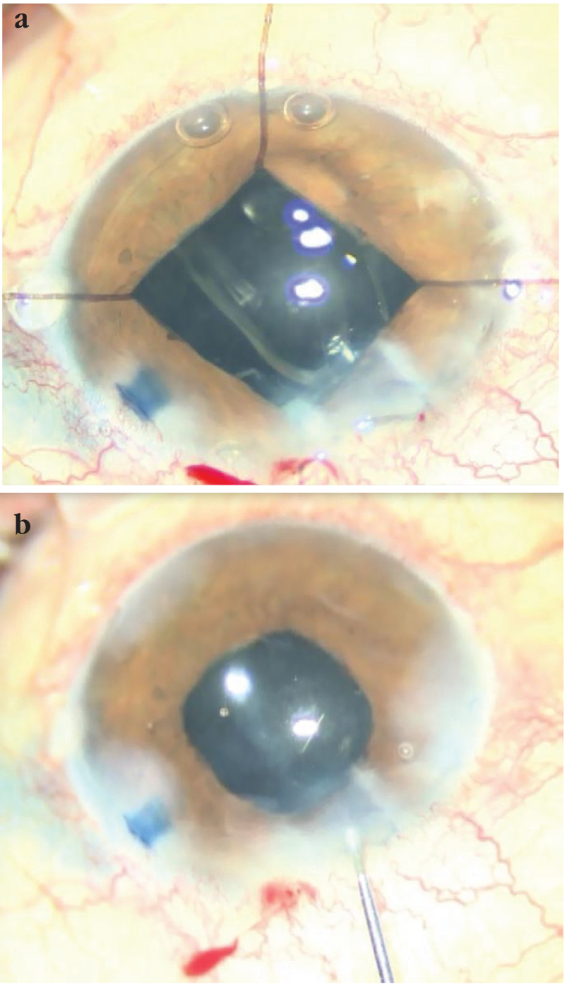 Unintentional Staining of the Anterior Vitreous with Trypan Blue During