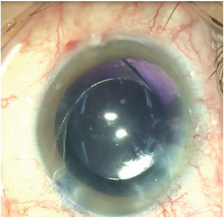 Unintentional Staining of the Anterior Vitreous with Trypan Blue During