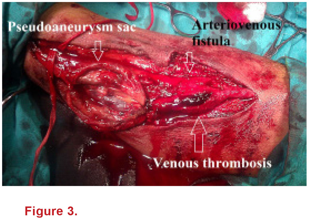 Giant pseudoaneurysm of basilic vein complicating arteriovenous fistula