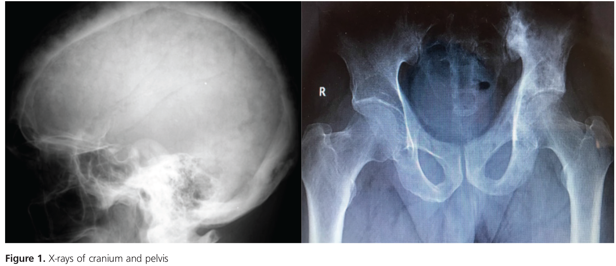 Paget’s Disease Diagnosed on Cranial and Sacroiliac Involvement in Contrast to Normal Alkaline