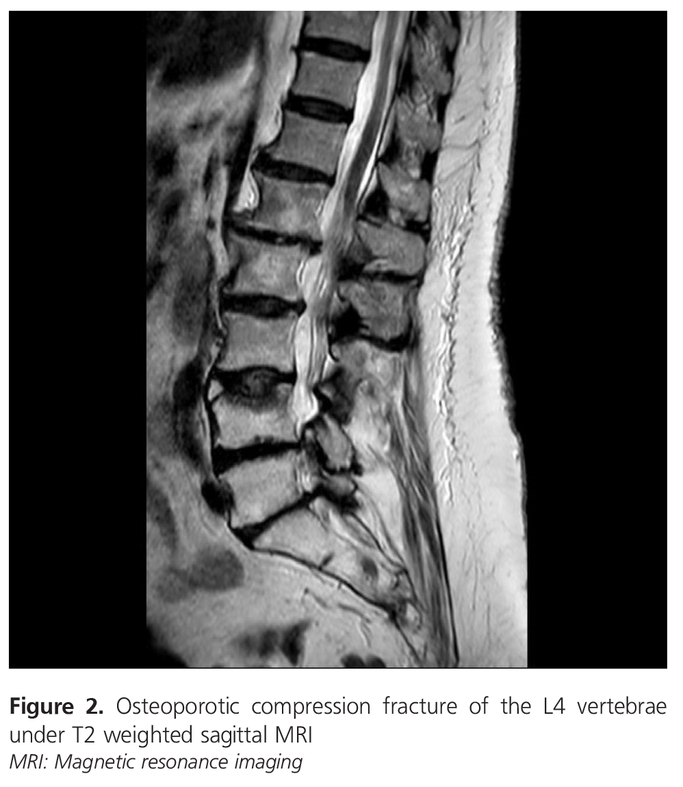 An Osteoporotic Vertebral Fracture Case After Lumbar Sympathetic An osteoporotic vertebral fracture case after lumbar sympathetic