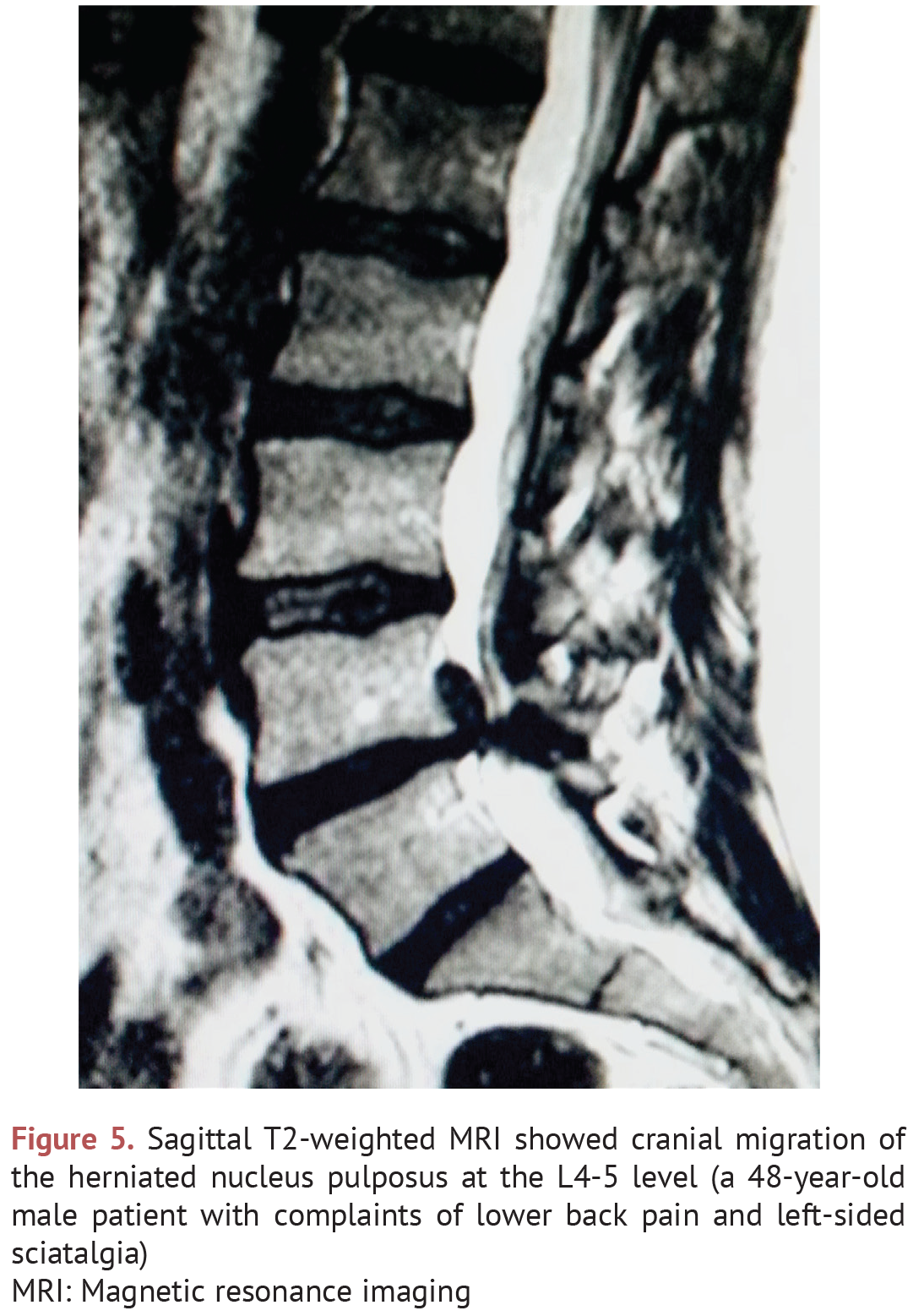 SPONTANEOUS REGRESSION OF LUMBAR DISC HERNIATIONS The Journal of