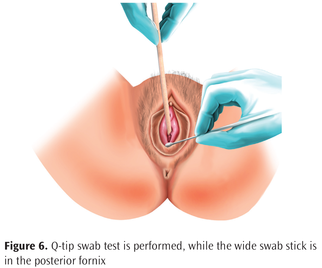 Oq toplar shaklida vaginal oqindi Oq toplar shaklida vaginal oqindi