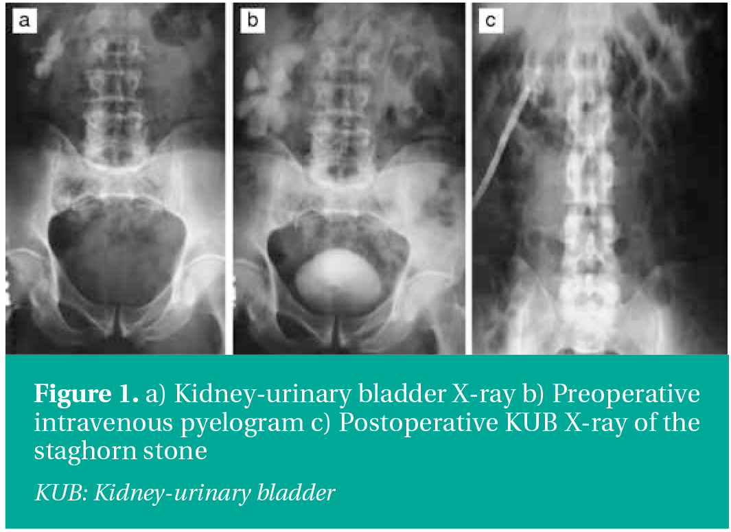 The Comparison of Two Versus More Than Two Tracts Percutaneous ...