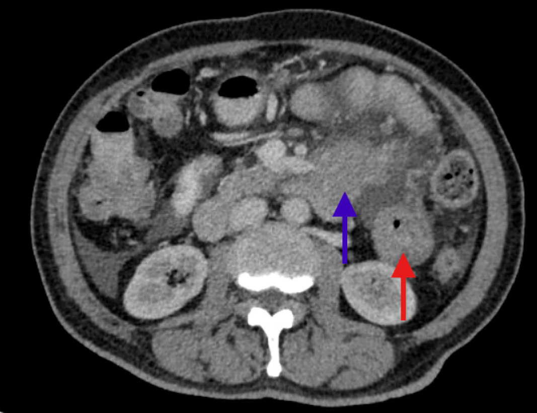 CT of Acute Abdomen 第3版 CT of acute abdomen in the elderly | Insights into Imaging