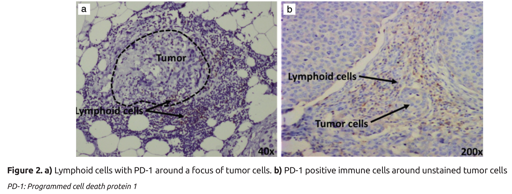 PD-1 and PD-L1 Expression in Indian Women with Breast Cancer - European ...