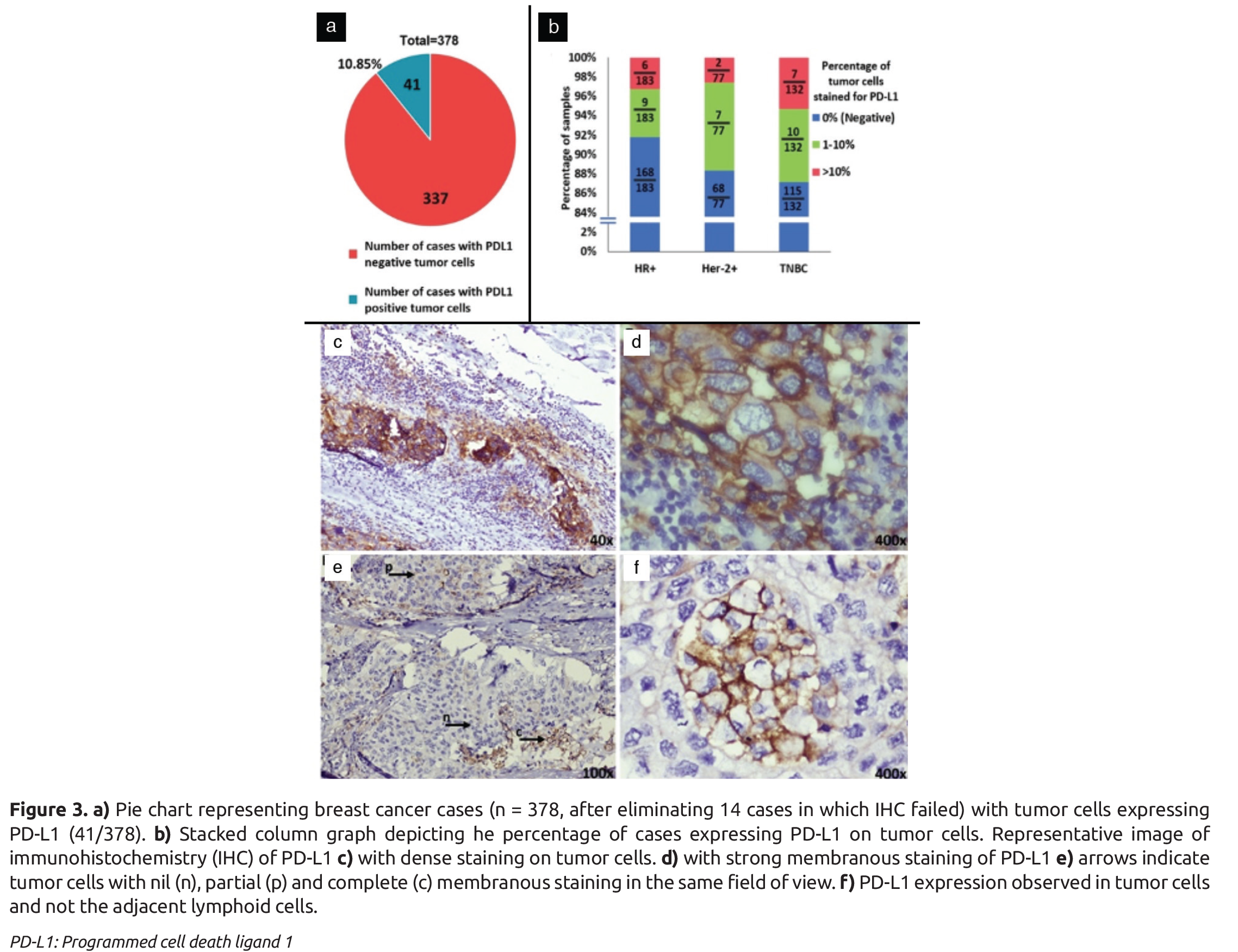 PD-1 and PD-L1 Expression in Indian Women with Breast Cancer - European ...