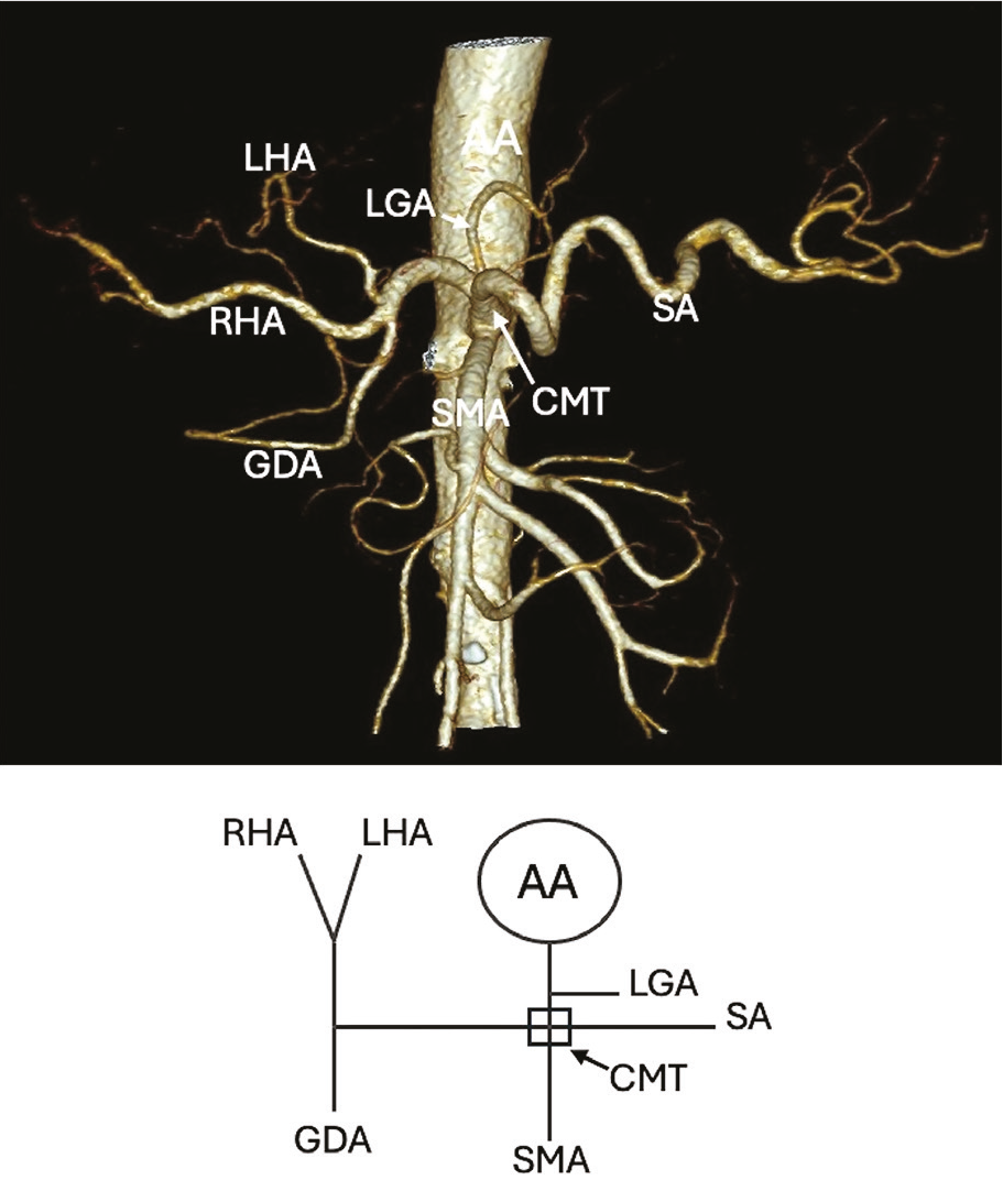 Seagull Sign on POCUS - Celiac Artery Trunk Anatomy Celiac ... | GrepMed, image size:911x1082
