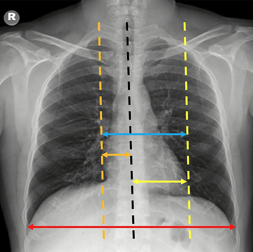 How To Calculate Cardiomegaly In Chest X Ray Mild Cardiomegaly Stock