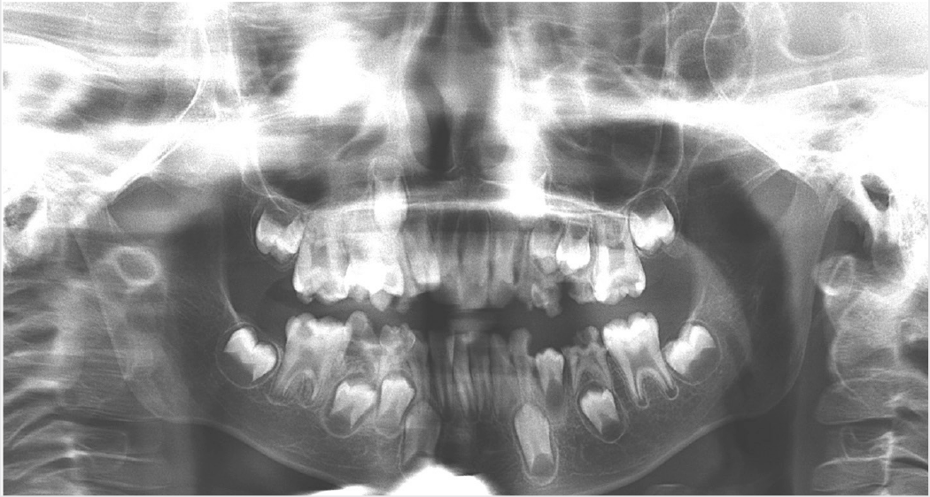Dental Treatment of Two Children with Niemann Pick Disease Type B Under