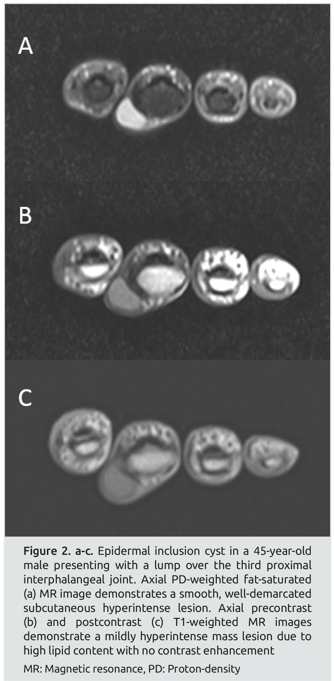 Radiological Appearences of Benign Soft-tissue Tumors of the Hand and ...