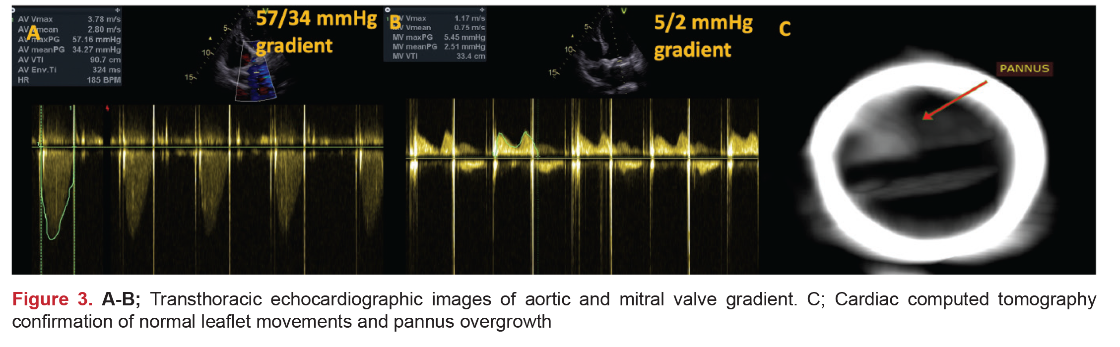 Stuck Leaflets in Prosthetic Heart Valves with Different Etiology and