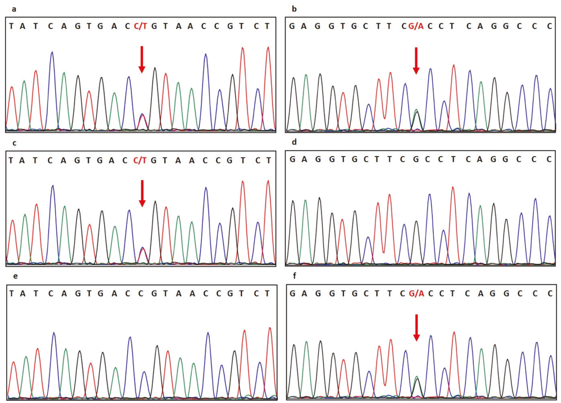 【貴重！！】Loz'a≠Veria（ロズ・ア・ベリア）／genetic code A Large Family with p.Arg554His Mutation in ABCD1: Clinical